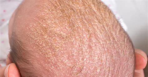 Bildvergleich: Milchschorf auf der Kopfhaut eines Säuglings, Windelausschlag am Po, typische Ekzeme bei Neurodermitis in den Gelenkbeugen.
