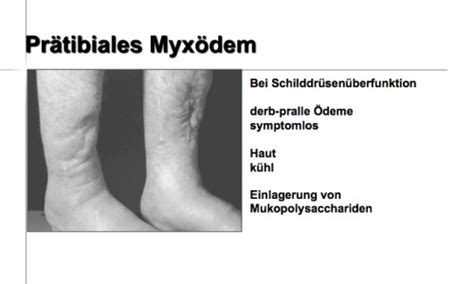 Prätibiales Myxödem bei Morbus Basedow