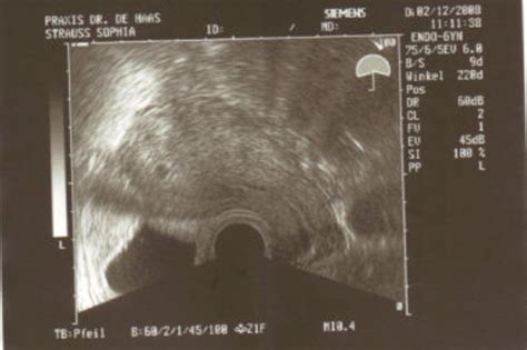Ultraschallbild eines Fetus im 1. Trimester mit Hervorhebung der Nackentransparenz