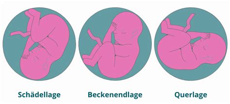 Illustration der Beckenendlage und der äußeren Wendung