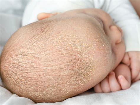 Babykopf mit Milchschorf und eine Flasche Calendula Öl