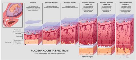 Schema, das die verschiedenen Grade des Plazenta accreta Spektrums darstellt