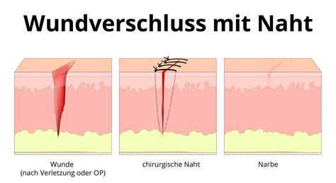 Darstellung einer Naht eines Dammrisses durch medizinisches Fachpersonal