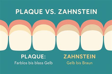 Schema zur Entstehung von Plaque auf Milchzähnen