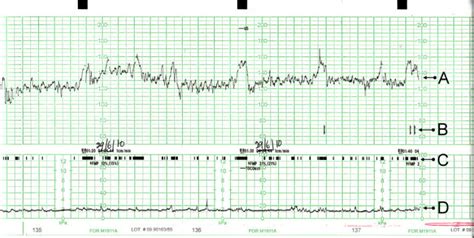 Beispiel eines CTG-Ausdrucks mit den Kurven für fetale Herzfrequenz und Wehentätigkeit