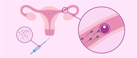 Schema der Intrauterinen Insemination (IUI) mit Darstellung der einzelnen Schritte von der Samenprobe bis zur Einbringung in die Gebärmutter.