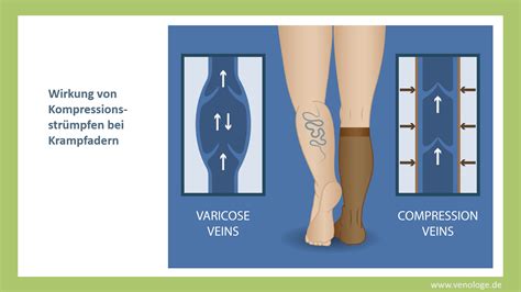 Schema der Venenfunktion und Wirkung von Kompressionsstrümpfen