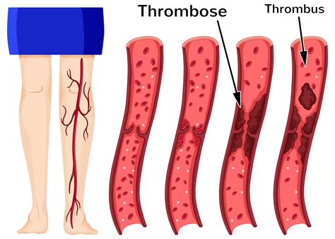 Illustration einer Thrombose im Bein