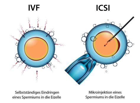 Grafik, die den Prozess der IVF und ICSI veranschaulicht