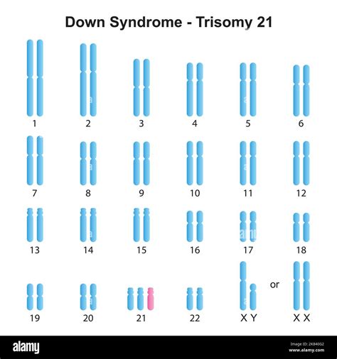 Darstellung der Chromosomenanordnung bei Trisomie 21