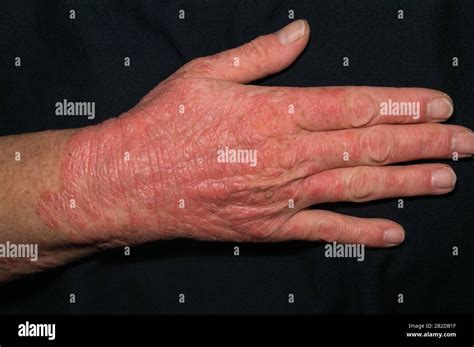 Darstellung des PUPPP-Syndroms mit typischen Hautveränderungen