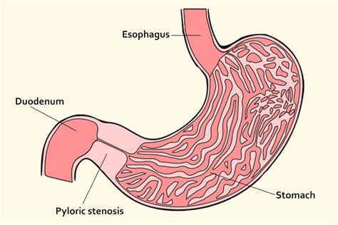 Schema, das die Pylorusstenose und den chirurgischen Eingriff zur Korrektur zeigt