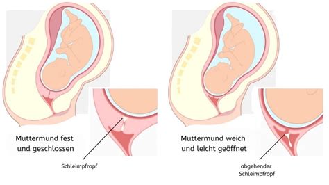 Schema einer frühen Schwangerschaft mit Darstellung des verschlossenen Muttermundes und des Schleimpfropfes