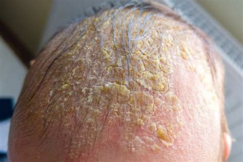 Darstellung von Milchschorf auf der Kopfhaut eines Babys mit gelblichen Krusten