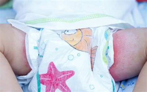 Nahaufnahme von Babyhaut mit Anzeichen von Windelausschlag und daneben eine Illustration von gesunder Haut.