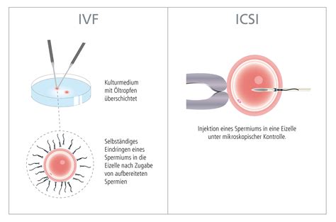 Schema der In-vitro-Fertilisation (IVF) und ICSI