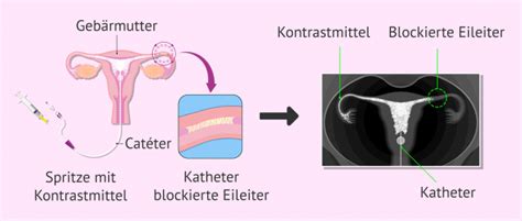 Röntgenbild einer Hysterosalpingographie, das eine durchgängige Eileiter zeigt