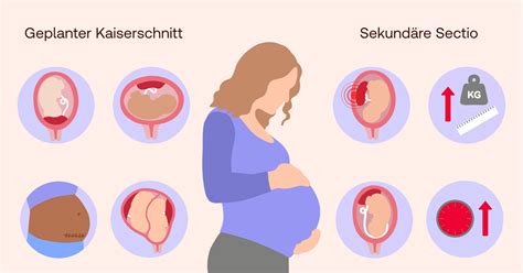 Grafische Darstellung der physiologischen Prozesse während einer vaginalen Geburt im Vergleich zu einem Kaiserschnitt.