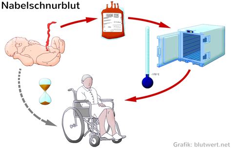 Schematische Darstellung der Gewinnung von Nabelschnurblut nach der Geburt.