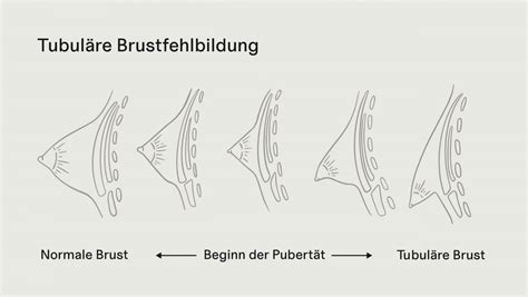 Schema, das den natürlichen Rückbildungsprozess der Brust nach dem Abstillen darstellt