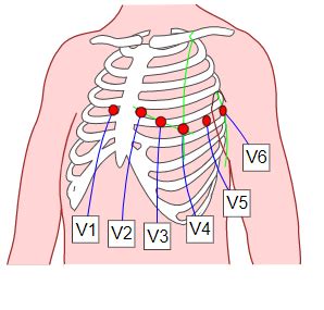 Schematische Darstellung der Platzierung von 10 Elektroden für ein 12-Kanal-EKG