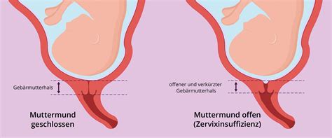 Grafische Darstellung des Gebärmutterhalses und Muttermundes zur Veranschaulichung von Verkürzung und Öffnung.