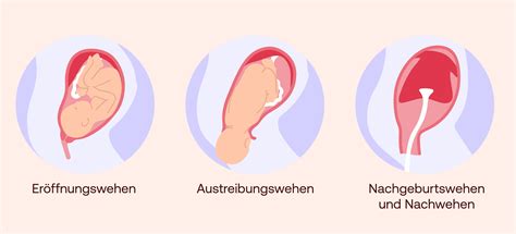 Schema, das die unregelmäßigen Kontraktionen von Braxton-Hicks-Wehen im Vergleich zu den regelmäßigen Wehen der Geburt zeigt.