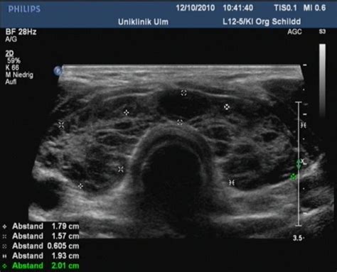 Ultraschallbild der Schilddrüse mit sichtbaren Knoten