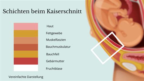 Schema der Schichten der Bauchdecke, die bei einem Kaiserschnitt durchtrennt werden.