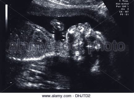 Ultraschallbild eines Fötus, der am Daumen lutscht