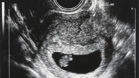 Ultraschallbild eines frühen Embryos