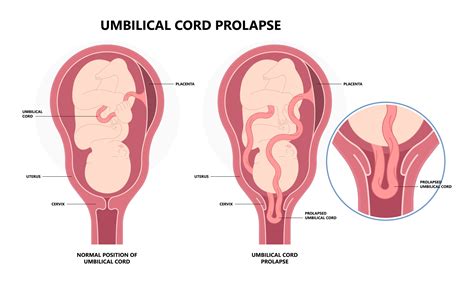 Illustration, die verschiedene Nabelschnurkomplikationen wie Umbilical Cord Prolapse und Nuchal Cord darstellt