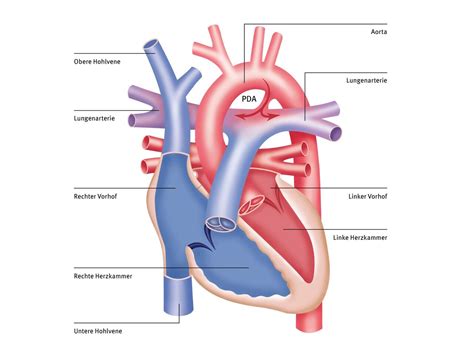 Schematische Darstellung des Ductus arteriosus und der möglichen Komplikationen bei Frühgeborenen.
