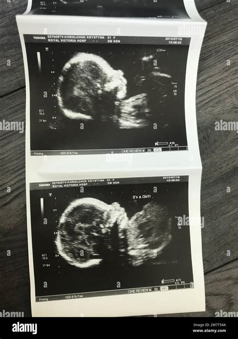 Röntgenbild eines Kindes mit Bronchiolitis, das typische Veränderungen zeigt