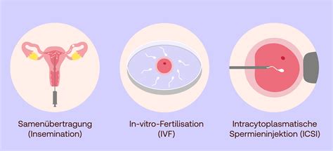 Schema der verschiedenen Methoden der künstlichen Befruchtung (Insemination, IVF, ICSI)