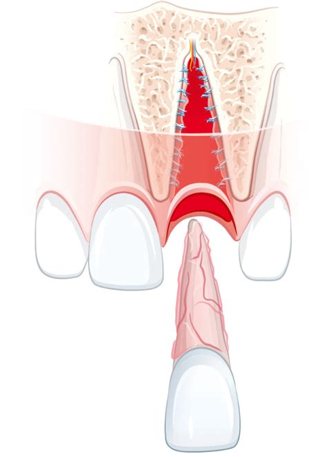 Eine Illustration, die zeigt, wie ein ausgeschlagener Zahn korrekt in einer Zahnrettungsbox aufbewahrt wird.