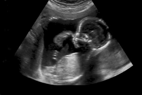 Ein Ultraschallbild von Zwillingen