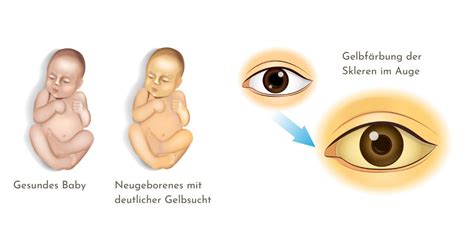 Vergleichsbild: Neugeborenes mit physiologischer Gelbsucht und Kleinkind mit Karotinämie