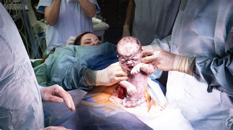 Ein Neugeborenes wird direkt nach dem Kaiserschnitt von einer Hebamme gehalten und auf die Brust der Mutter gelegt.