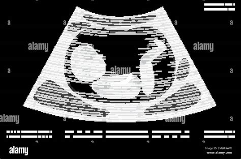 Illustration der fetalen Biometrie-Messungen im Ultraschallbild