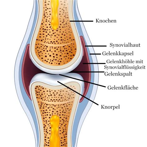 Illustration eines Knies mit sichtbarer Schwellung und Flüssigkeitsansammlung im Gelenkspalt