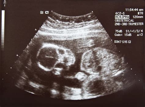 Ultraschallbild eines Fötus im zweiten Trimester