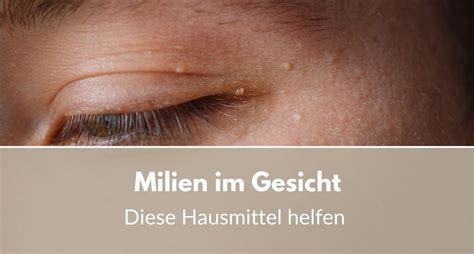 Illustration von Milien im Gesicht eines Neugeborenen, die sich als kleine weiße Pünktchen auf Nase, Stirn und Wangen zeigen.