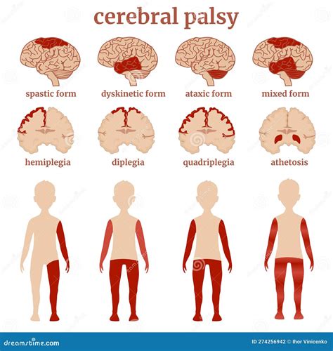 Ein Diagramm, das die verschiedenen Formen der Zerebralparese (spastisch, dyskinetisch, ataktisch, gemischt) und ihre Hauptmerkmale darstellt.