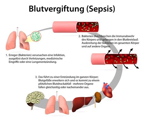 Eine schematische Darstellung des Kreislaufs einer bakteriellen Infektion, die zu einer Sepsis bei einem Neugeborenen führen kann.