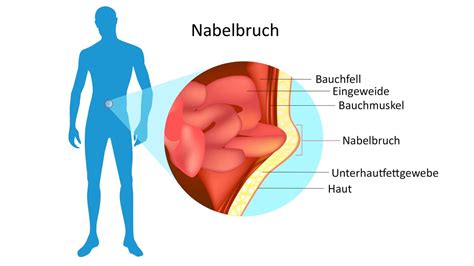 Schema des Nabelrings und der Bauchwandmuskulatur, das eine normale Schließung und eine Nabelhernie mit Bruchsack vergleicht