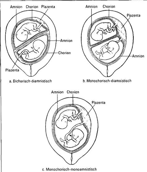 Schema einer Zwillingsschwangerschaft mit unterschiedlichen Plazenta- und Fruchtblasenkonstellationen