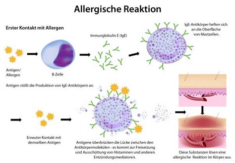 Grafik, die die Reaktion des Immunsystems bei einer schweren Allergie zeigt