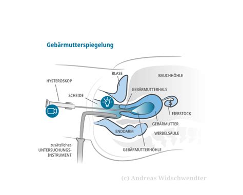 Schematische Darstellung einer Gebärmutterspiegelung (Hysteroskopie)