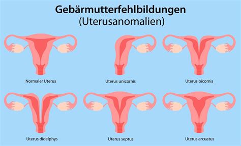 Grafische Darstellung des Gebärmutterhalses mit Hervorhebung von Krebsvorstufen